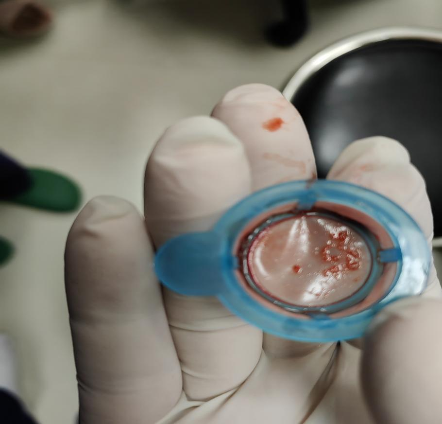 thrombus thrombus